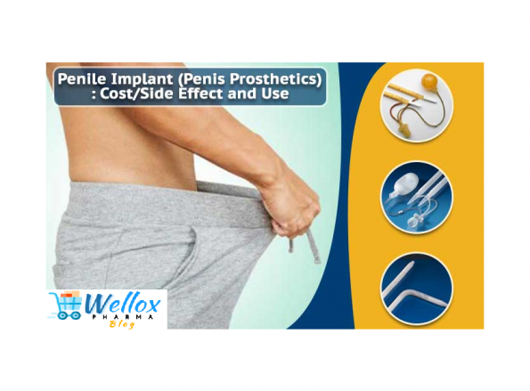 Penile Implant For Erectile Dysfunction
