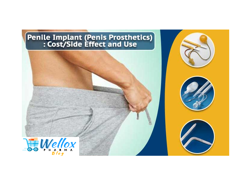Penile Implant For Erectile Dysfunction